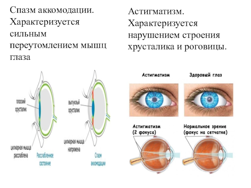 Исследование аккомодации глаза: показания и особенности метода